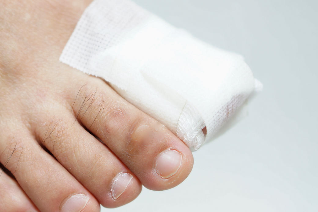 leczenie grzybicy paznokci