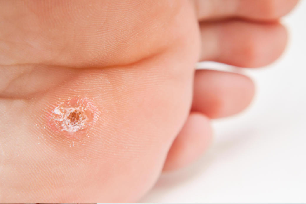 Leczeni odcisków na stopach